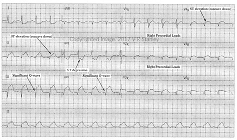 Dsae Stemi Review Mod 1 Examples Of Posterior And Right Ventricular