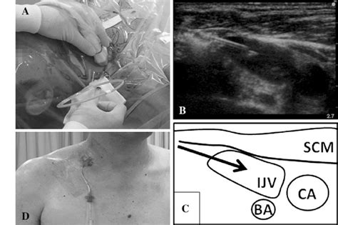 Supraclavicular Central Venous Puncture A The Ultrasound Transducer Is