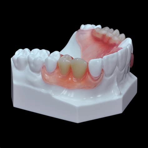 Gd 07 Flexible Partial Upper Denture Paradigm Dental Models