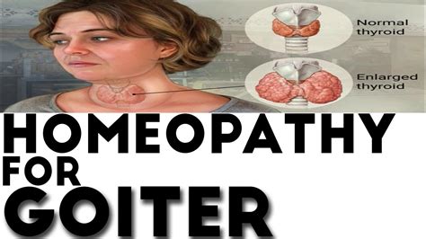 Homeopathic Treatment For Goiter By Dr Ps Tiwari Youtube