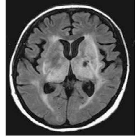 Brain Magnetic Resonance Imaging Mri Findings The Fluidattenuated Download Scientific