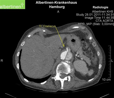 Ct Aortic Dissection At The Level Of The Liver Doccheck