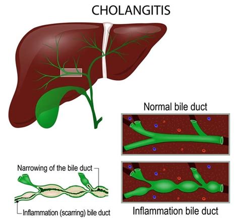 What Is Acute Cholangitis Human Digestive System Bile Duct Medical
