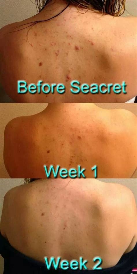 Mud Soap Seacret Skincare Back Acne Remedies Dry Skin Care