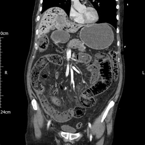 Computed Tomography With Intravenous Contrast Of Abdomen And Pelvis
