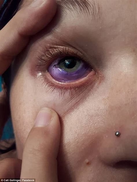 canadian model s eye tattoo goes horribly wrong daily mail online