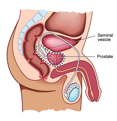 Prostatectomy Abanhospital