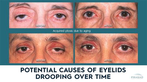 Possible Causes Of Drooping Eyelids Eyelid Ptosis In Adults Youtube
