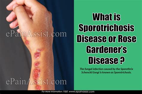 Sporotrichosis Or Rose Gardeners Diseasetypestransmissionsymptoms
