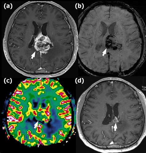 Radionecrosis In A 41 Year Old Man With Glioblastoma In The Left Mid