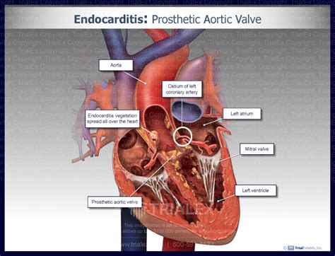 Endocarditis Prosthetic Aortic Valve Trialexhibits Inc