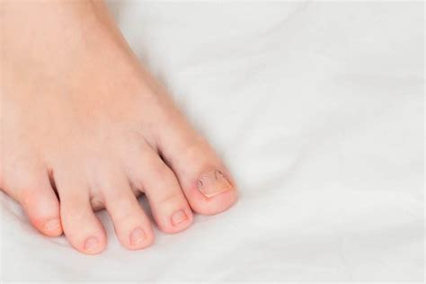 The Simple Guide To Ingrown Toenails Pod Fit Podiatry