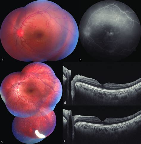 A Fundus Photograph Of Case 4 With Vitritis And Cystoid Macular Edema