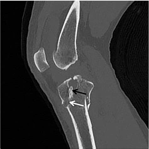 Figure 1 From Rehabilitation Of Tibial Plateau Fracture Following
