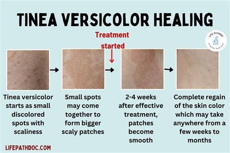 Tinea Versicolor Healing Stages Pictures And Treatment