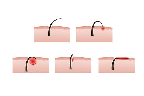 Ingrown Hair Left Untreated Ingrown Hair Cyst Treatments Causes And