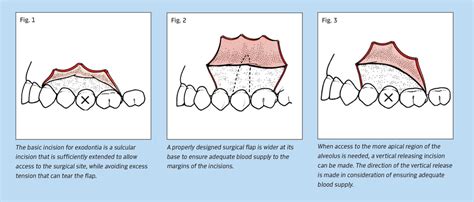 Principles Of Flap Design And Closure By Jay B Reznick Dmd Md