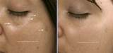 Skin Discoloration After Laser Treatment Pictures