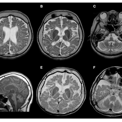 A D Brain Magnetic Resonance Imaging Findings Of This Patient At Download Scientific