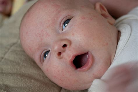 Baby Eczema Acne Genie