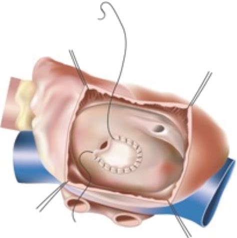 Surgical Closure Of Atrial Septal Defects Liavaa Journal Of