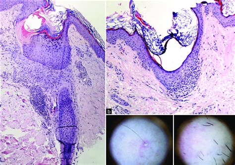 A Histopathology Of Lower Limb Shows Mild Follicular Hyperkeratosis