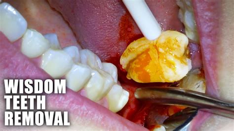 Full Wisdom Teeth Removal Procedure Emergency Extraction Of Impacted