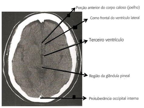 Anatomia Radiológica Do Crânio