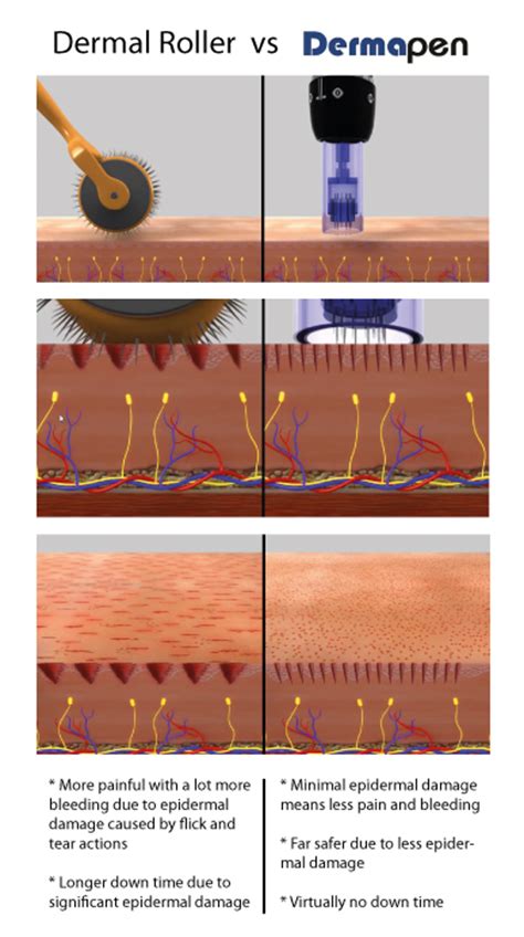 Dermapen Advanced Microneedling For Skin Tightening Wrinkles Acne