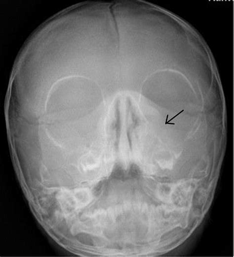 Unilateral Facial Swelling In An Infant Journal Of Pediatric Surgery