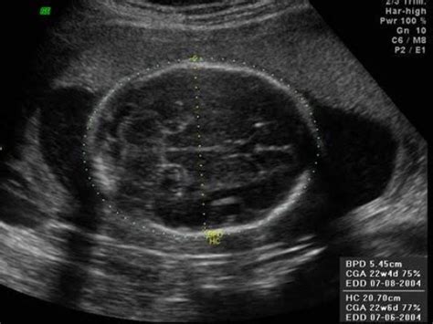 The Ultimate Guide For Your 21 Week Ultrasound Ultrasoundfeminsider