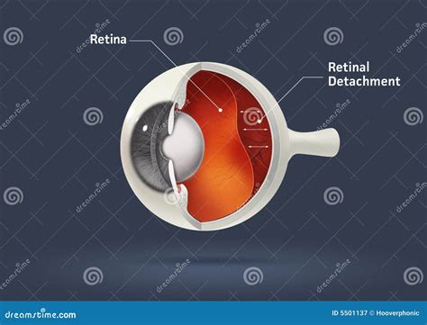 Human Eye Retinal Detachment Stock Illustration Illustration Of