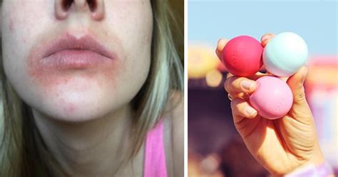 Update After Customers Get Painful Rashes And Blisters From Eos Lip