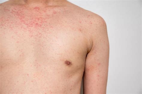 Dermatite éruption Cutanée Maladie Virale Avec Immunodéficience Sur Le