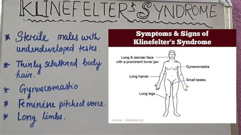 KLINEFELTER SYNDROME XXY Signs Symptoms YouTube
