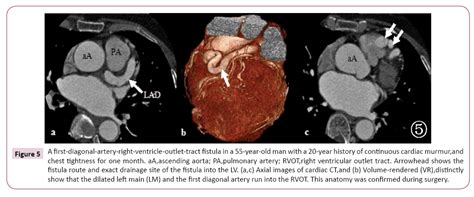 Evaluation Of The Complex Coronary Artery Fistula With Slice Computed Tomography Paying