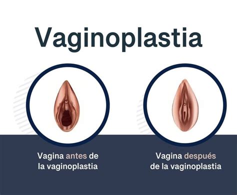 Vaginoplastia Vaginoplasty Rejuvenecimiento Vaginal Laser Y Cirugia My XXX Hot Girl