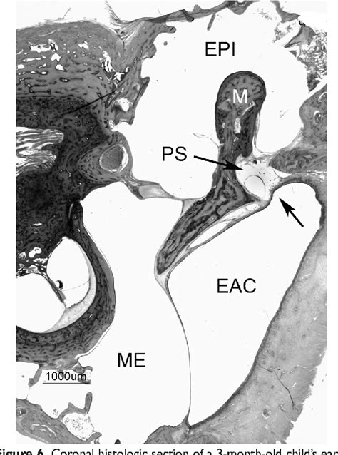 Figure 6 From Endoscopic Anatomy Of The Pediatric Middle Ear Semantic