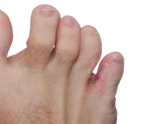 What Is Toe Jam Characteristics And Treatment With Pictures