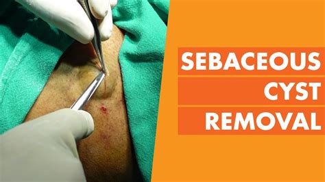 Sebaceous Cyst Removal Painless And Scarless Treatment By Dr Prashant