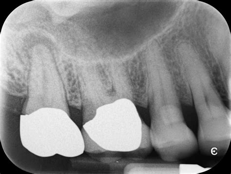 Maxillary Sinusitis Of Endodontic Origin Mseo Seattle Endodontics