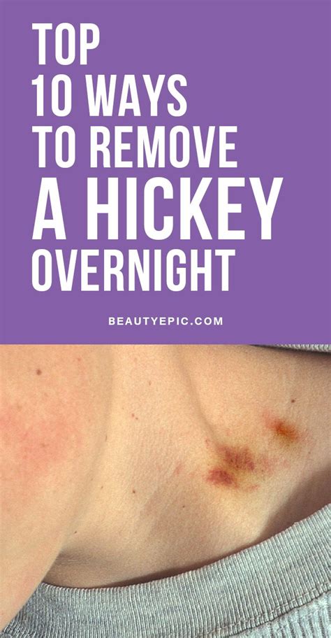 Top 10 Easy Ways To Get Rid Of A Hickey Overnight Hickeys How To Hide Hickeys Get Rid Of Hickies