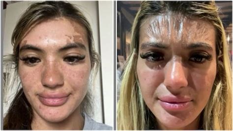British Woman Wakes Up To Scary ‘plastic Skin’ After Falling Asleep While Sunbathing India Today