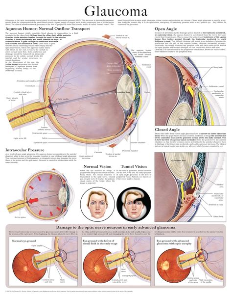 Amazon Com Glaucoma E Chart Full Illustrated EBook HC HealthComm