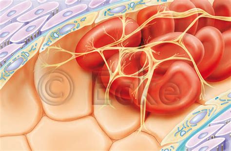 Canlıda, fibrin, kan pulcuğu ve hücresel elemanlardan oluşan, oluştuğu noktada damarın veya kalbin iç yüzünün tıkanmasına neden olan kan pıhtısı. Thrombus 1