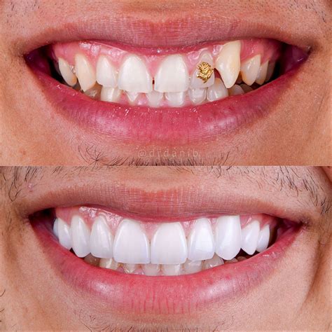 Cosmetic Dentistry Before After Photos Porcelain Veneers Pictures