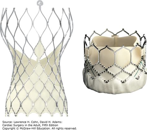 Stented Bioprosthetic Aortic Valve Replacement Thoracic Key