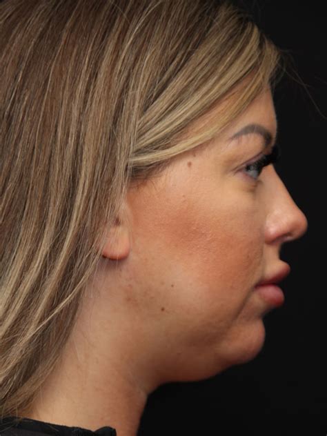 Patient Chin Implants C26 Solomon Facial Plastic