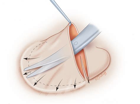 Microtia Repair Oto Surgery Atlas