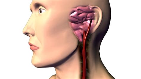 Carotid artery disease is a disease in which a waxy substance called plaque builds up inside the carotid arteries. Thinking, Memory Problems Tied to Blockages in Neck Artery ...